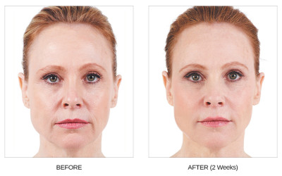 Learn About Cosmetic Fillers