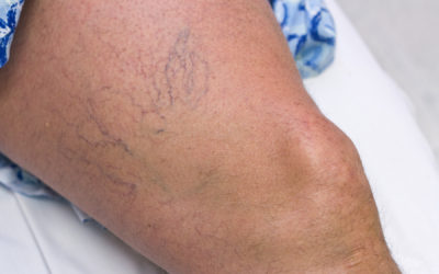 What You Should Know: Sclerotherapy for Spider Vein Treatment