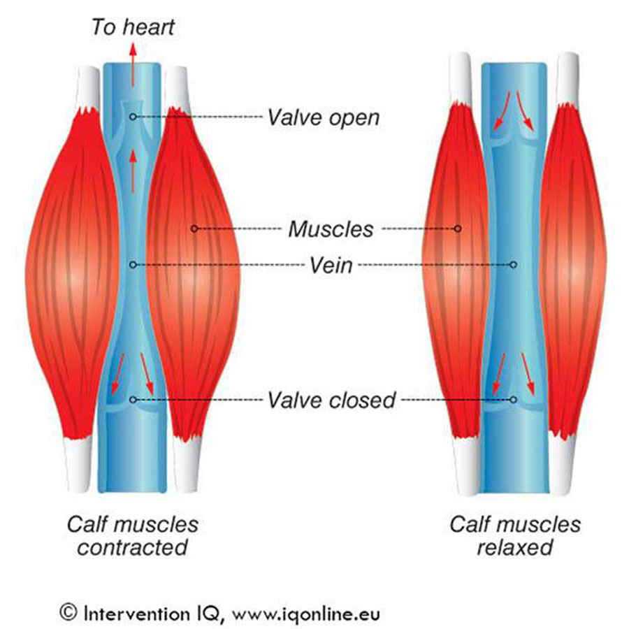 Importance of Calf Muscle Pump for Venous Health