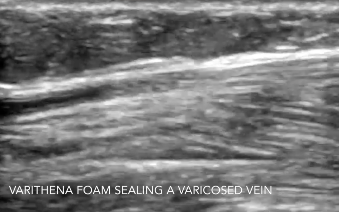 Watch Varithena Collapse a Varicose Vein