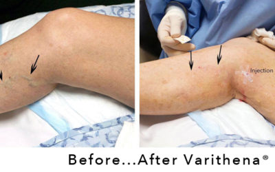 Reasons to Consider Varithena for Varicose Vein Treatment
