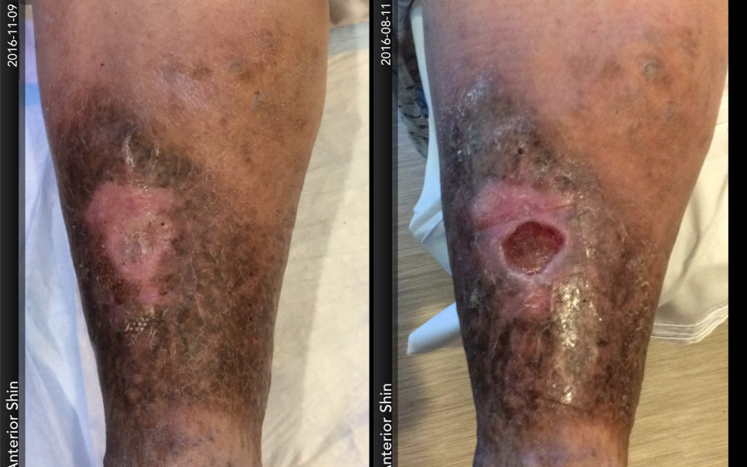 Those Varicose Veins Could Become a Problem: How Venous Insufficiency Can Lead to Leg Ulcerations