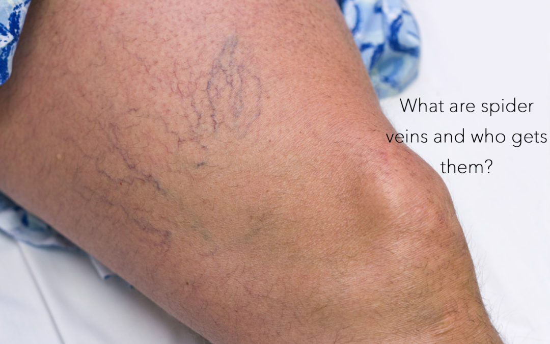 What Are Spider Veins And Who Gets Them?