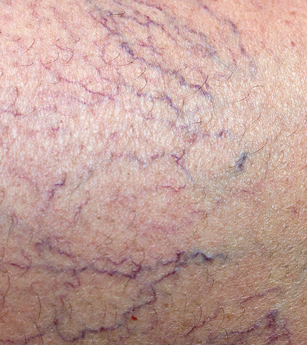 Spider Veins: Cosmetic or Problematic?