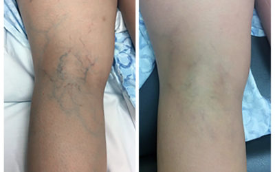 Spider Veins Before and After Sclerotherapy