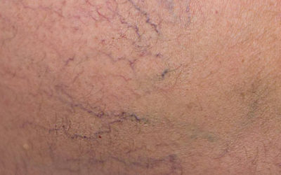Sclerotherapy: New Pricing