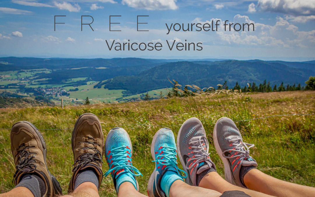 Is Varicose Vein Removal my only option??