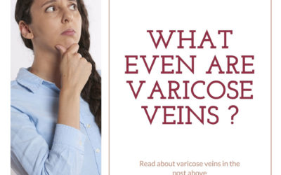 Veins 101: What even are Varicose Veins?