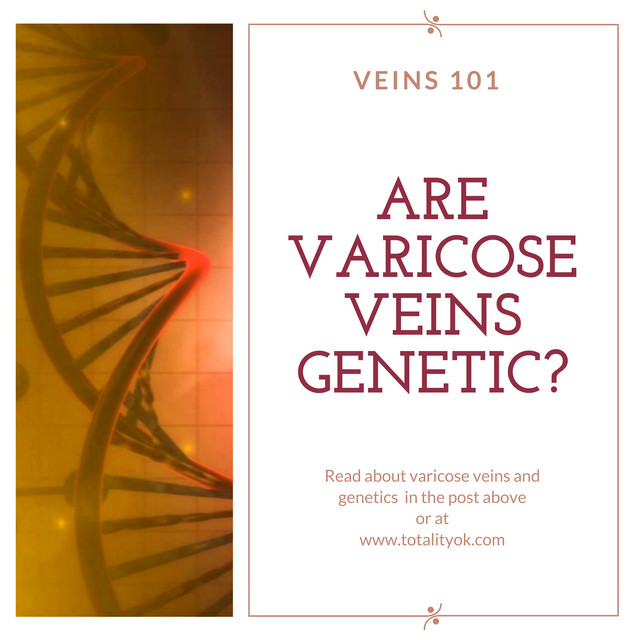Veins 101: Are Varicose Veins Genetic?