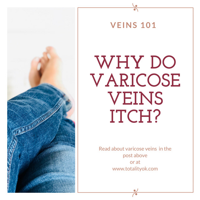 Veins 101: Why do Varicose Veins itch?